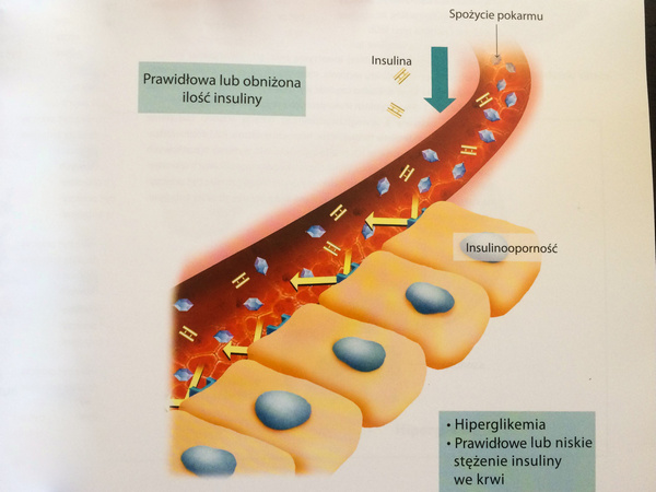 Insulinooporność 3